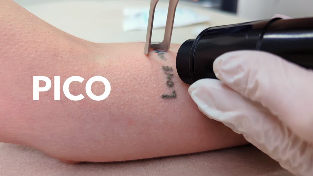 Usuwanie tatuażu laserem pikosekundowym – case study