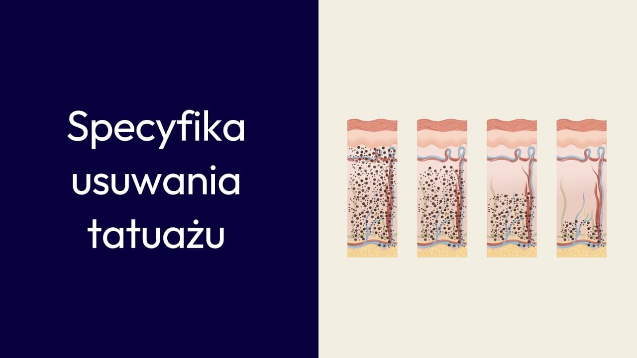 Specyfika usuwania tatuażu