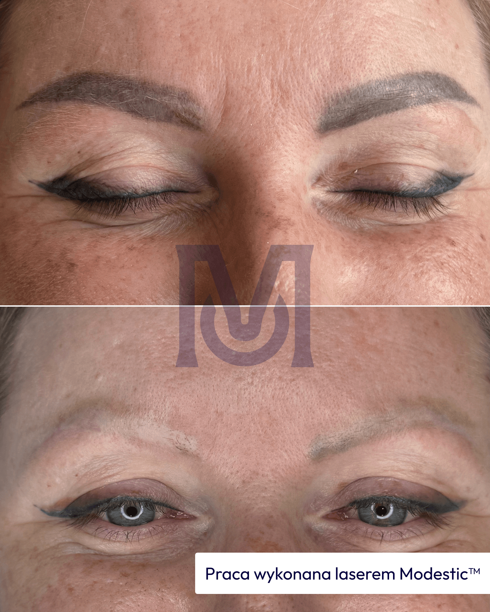 Modestic laser treatment result — brows before and after