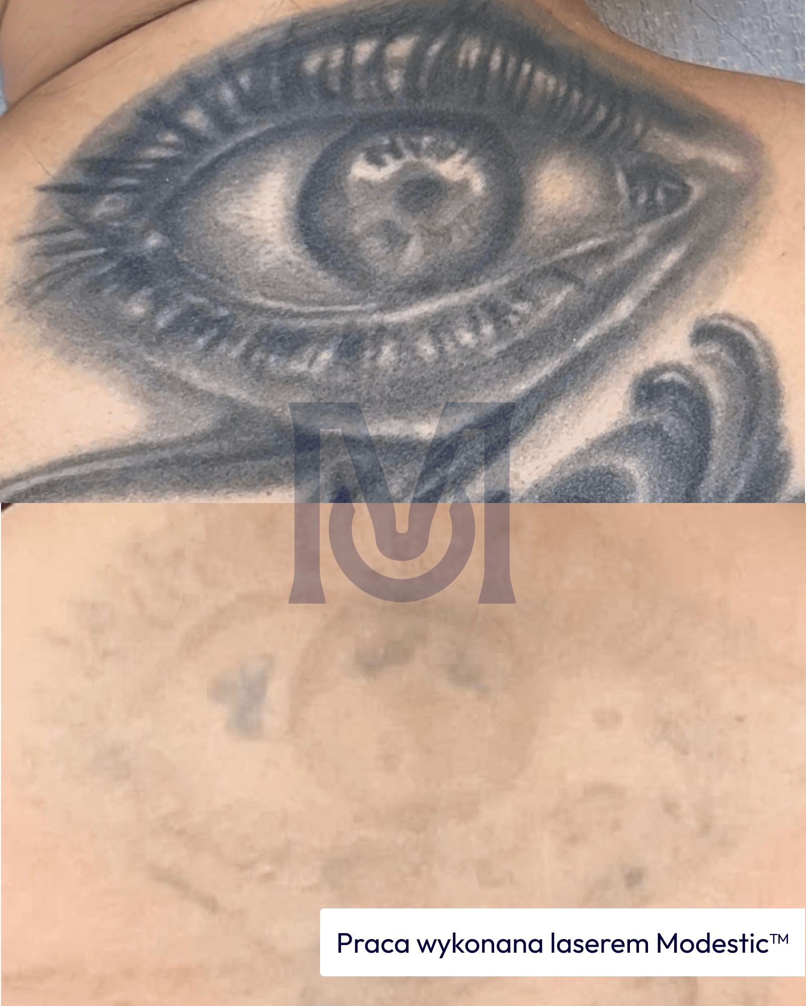 Tattoo removal with a Modestic laser — before and after