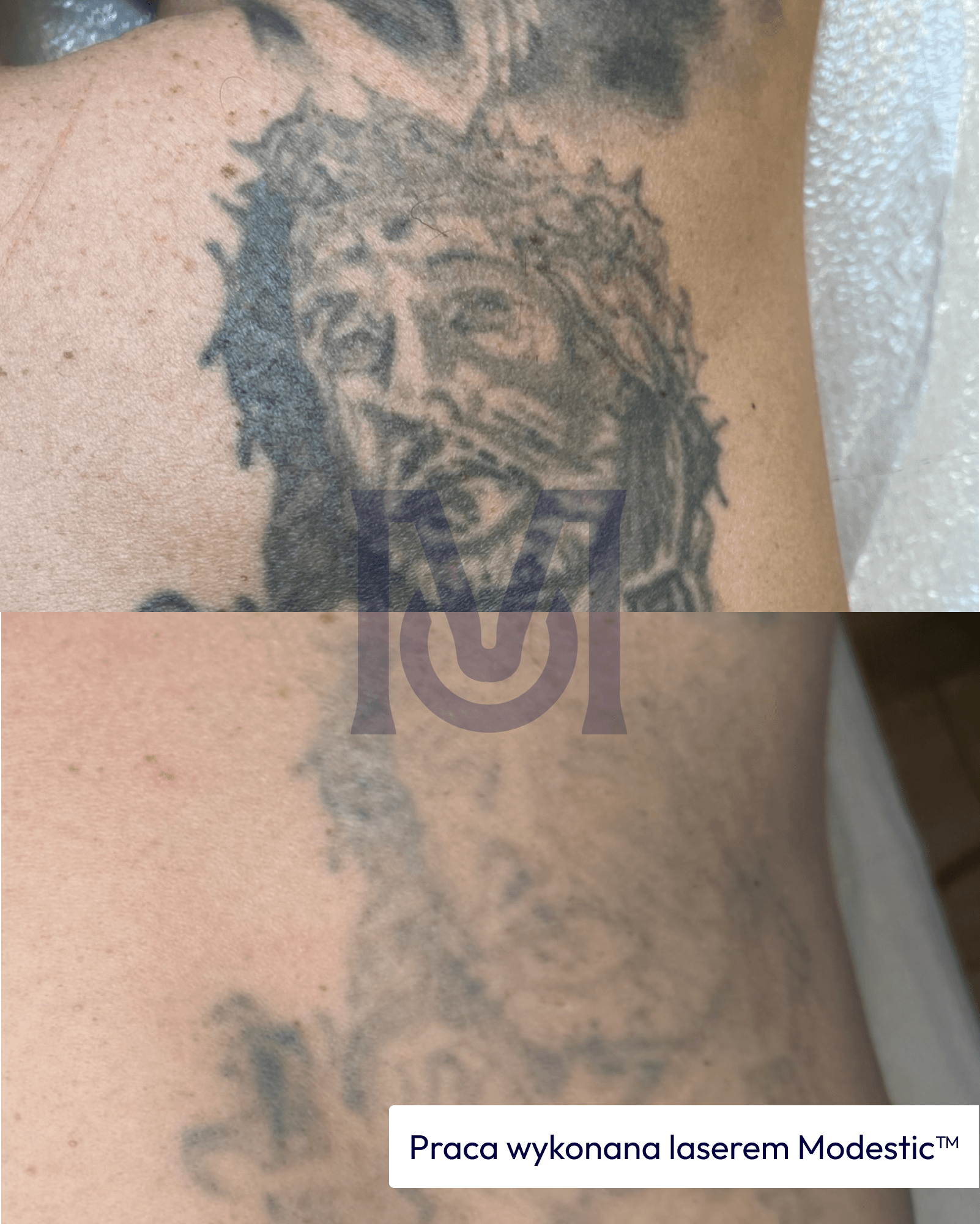 Tattoo lightening with a Modestic laser — before and after