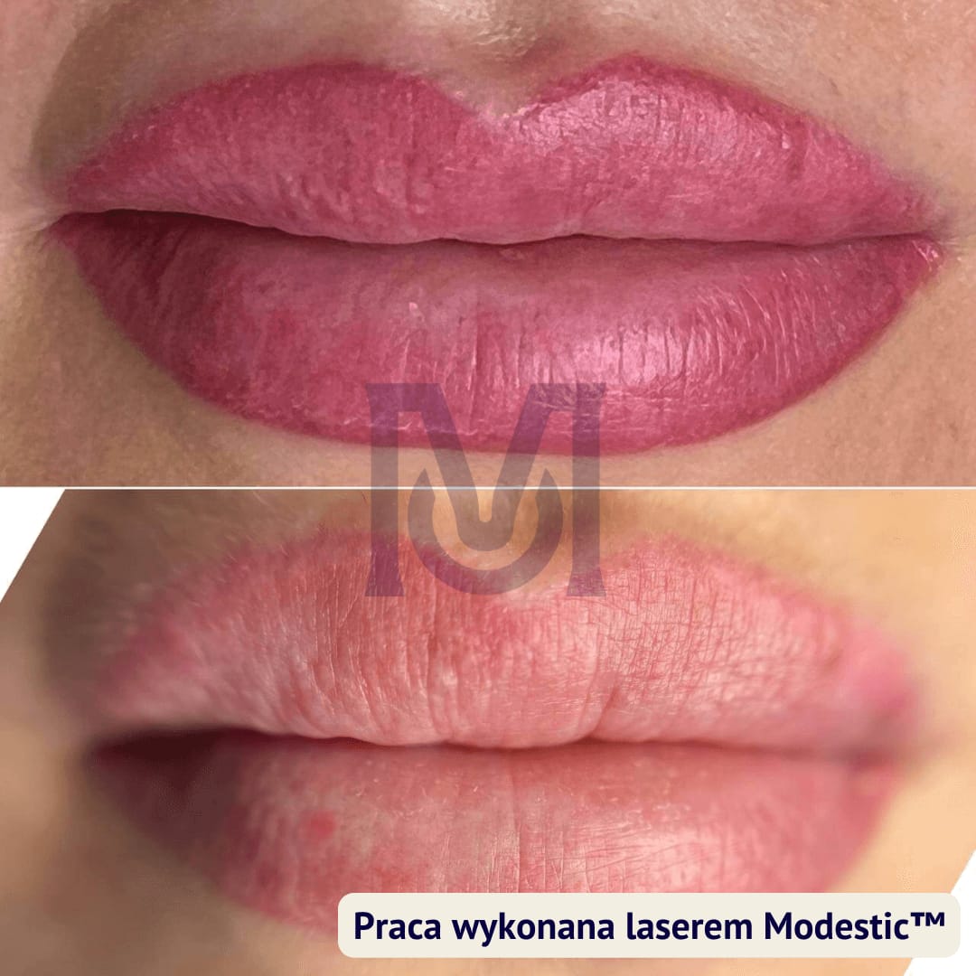 Zabieg laserowego usuwania pigmentu, operator i klient w okularach ochronnych