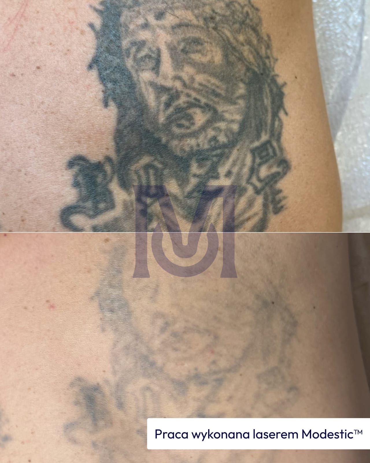 Blaknięcie czarnego tatuażu po kolejnych sesjach laserem Modestic