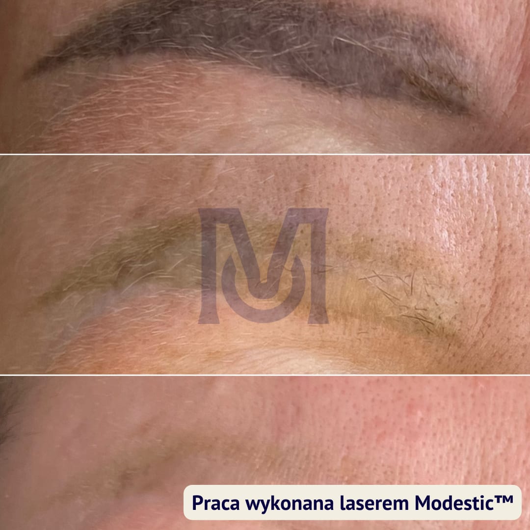 Brwi po makijażu permanentnym przed usuwaniem laserem i po serii zabiegów