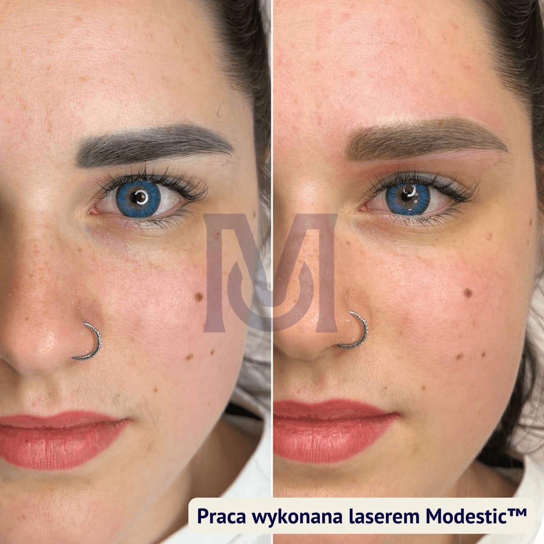 Efekt usuwania makijażu permanentnego brwi laserem, przed i po