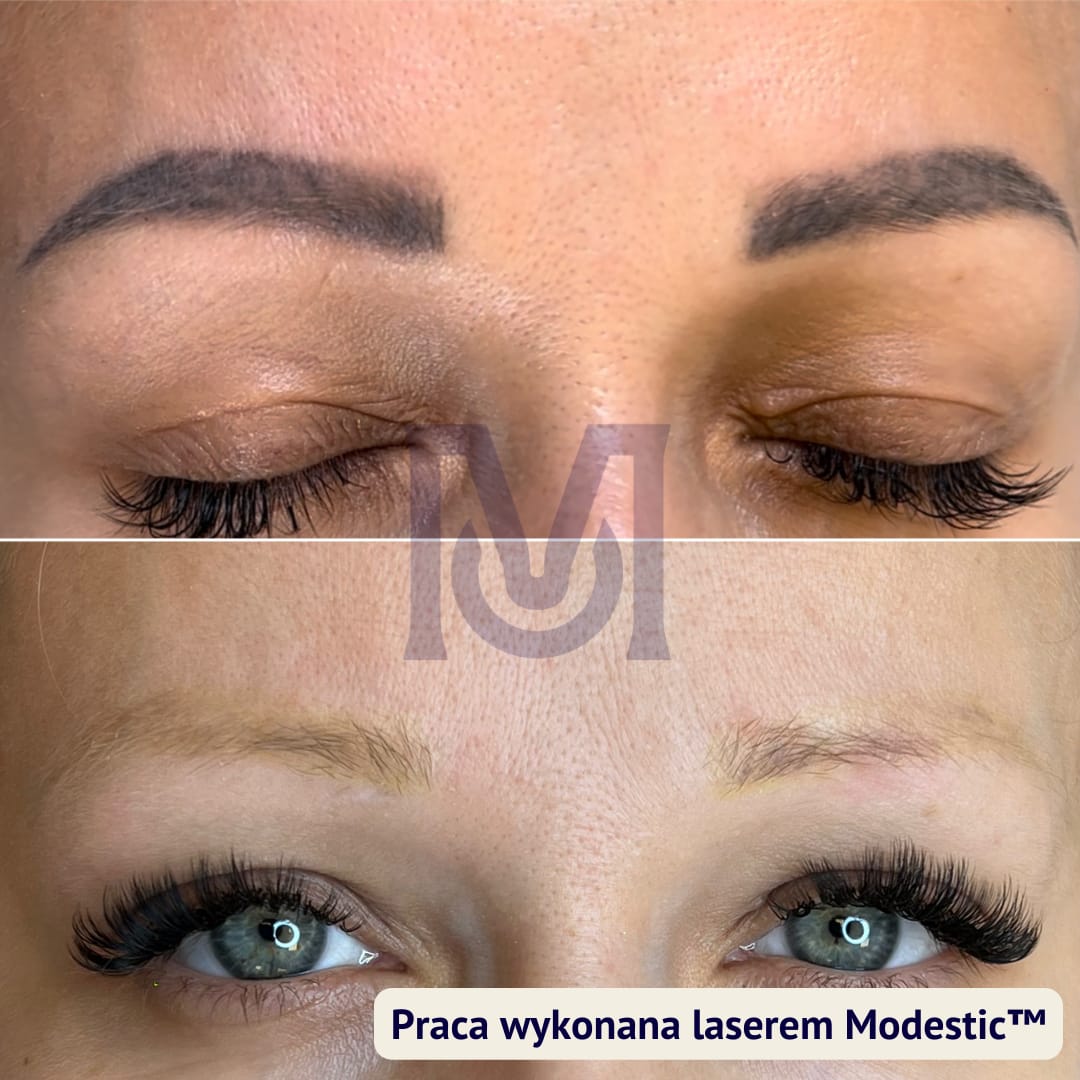 Przygotowanie stanowiska do zabiegu laserowego usuwania pigmentu