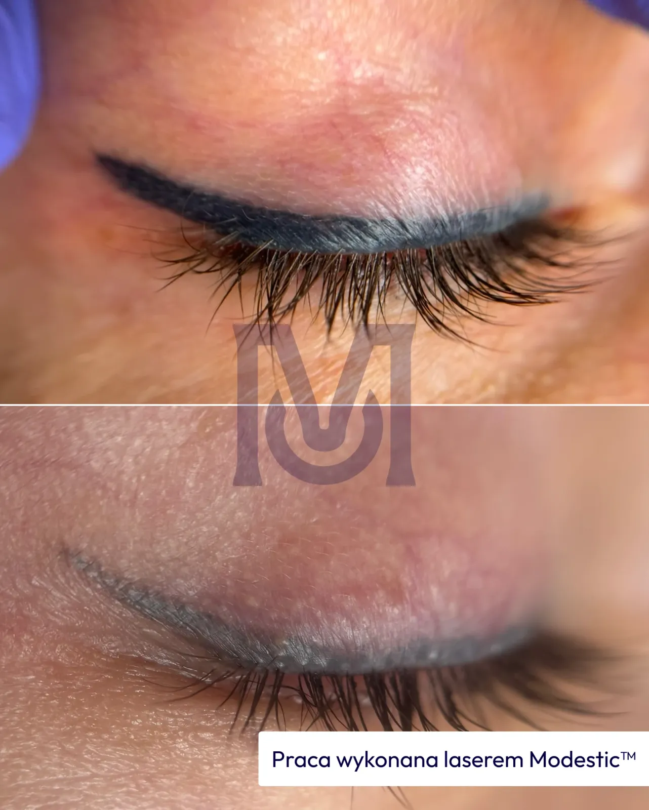 Result of work with a Modestic laser — 3