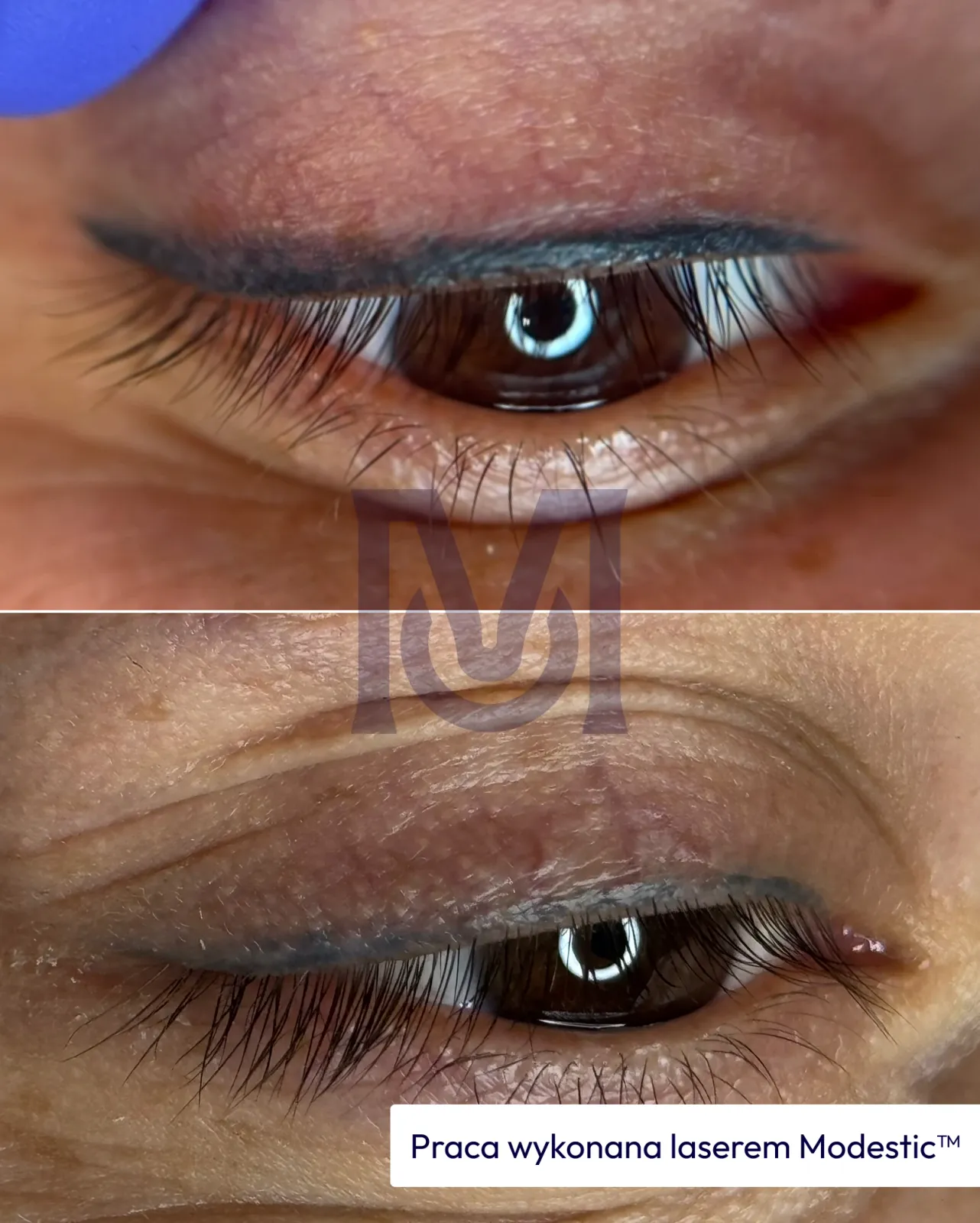 Result of work with a Modestic laser — 10