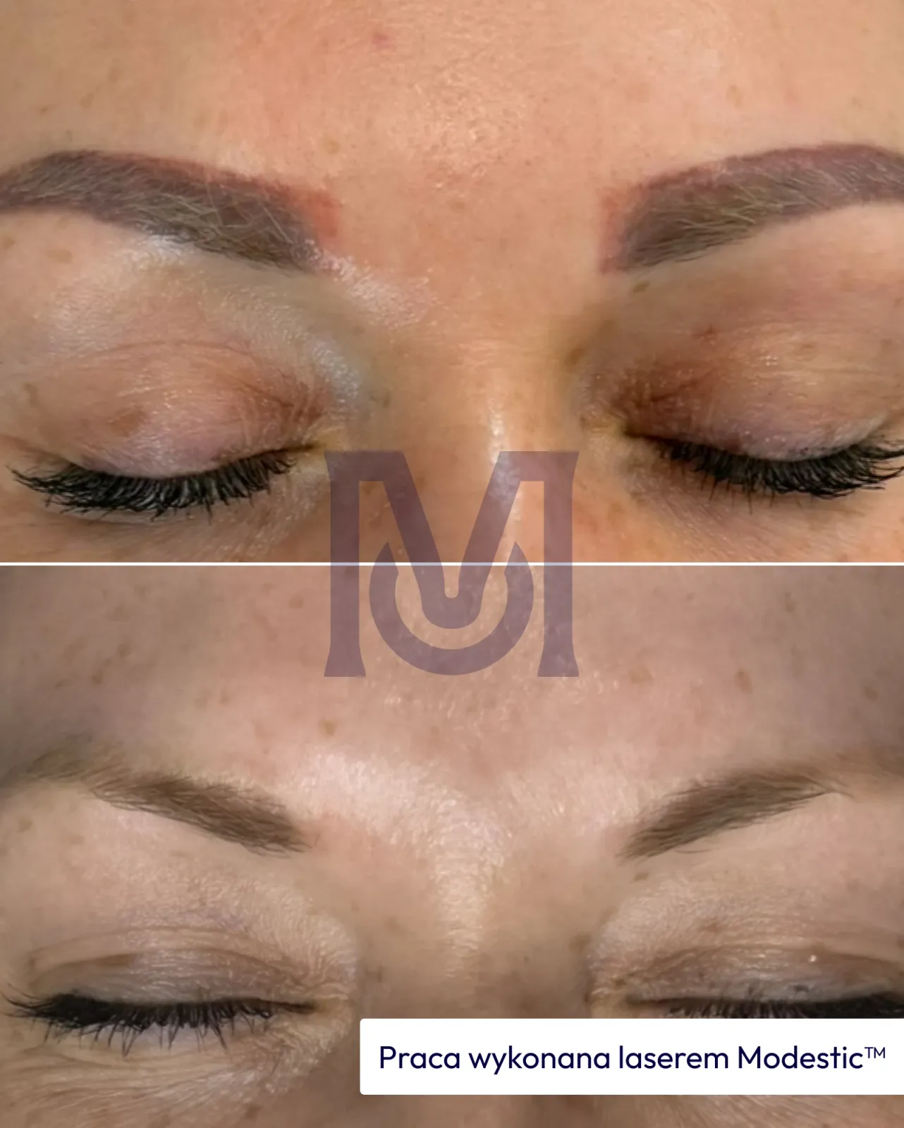 Result of work with a Modestic laser — 1