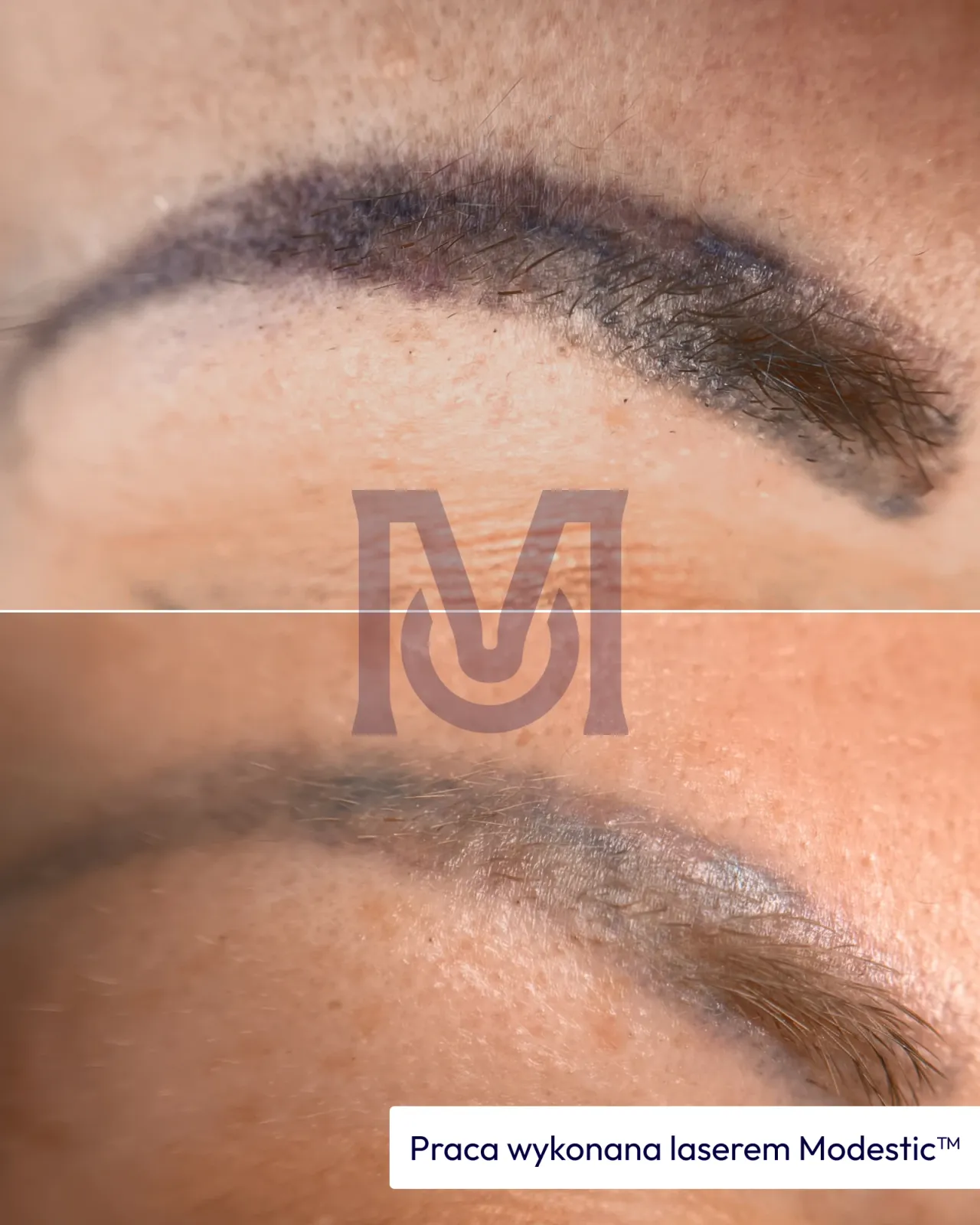 Result of work with a Modestic laser — 11