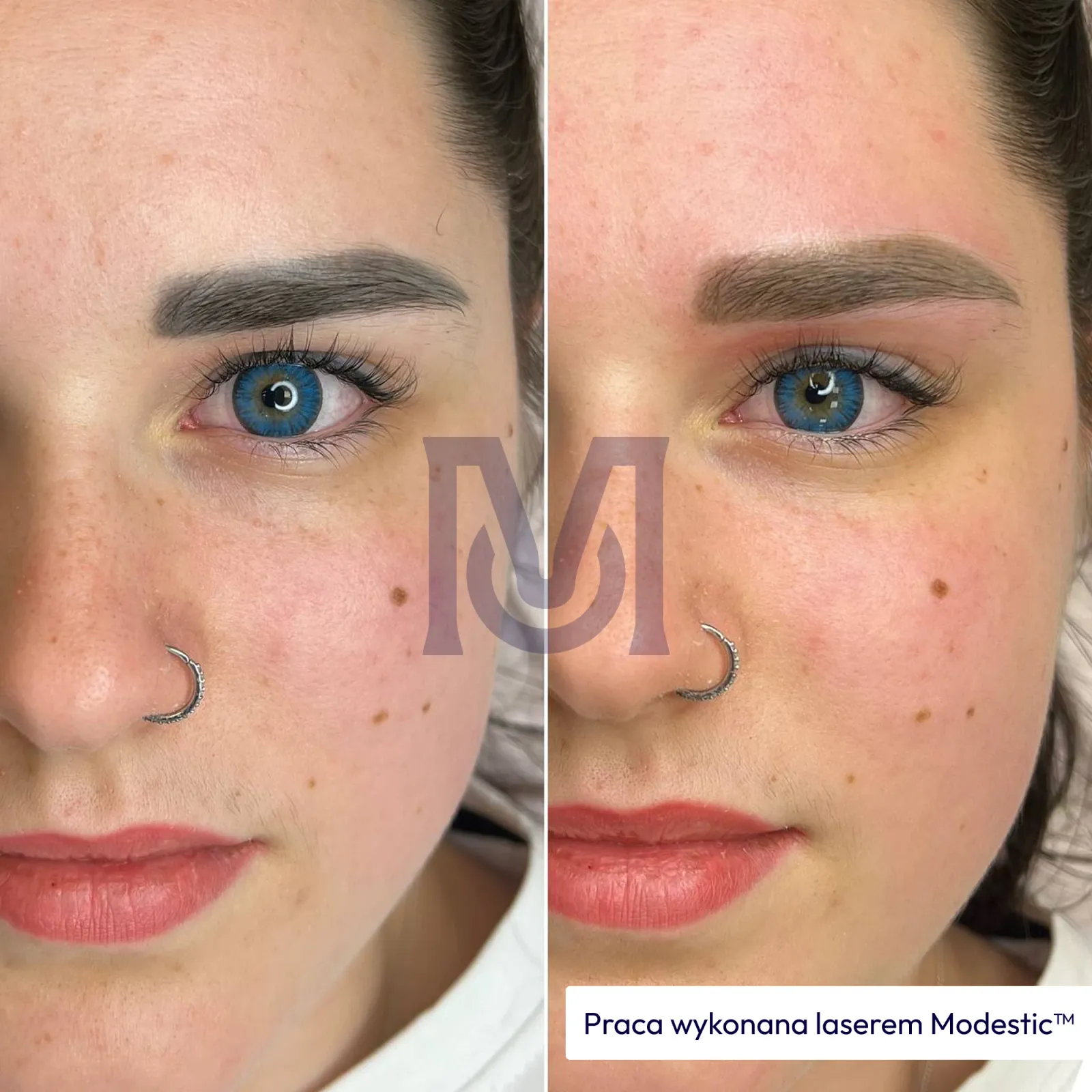 Result of work with a Modestic laser — 12