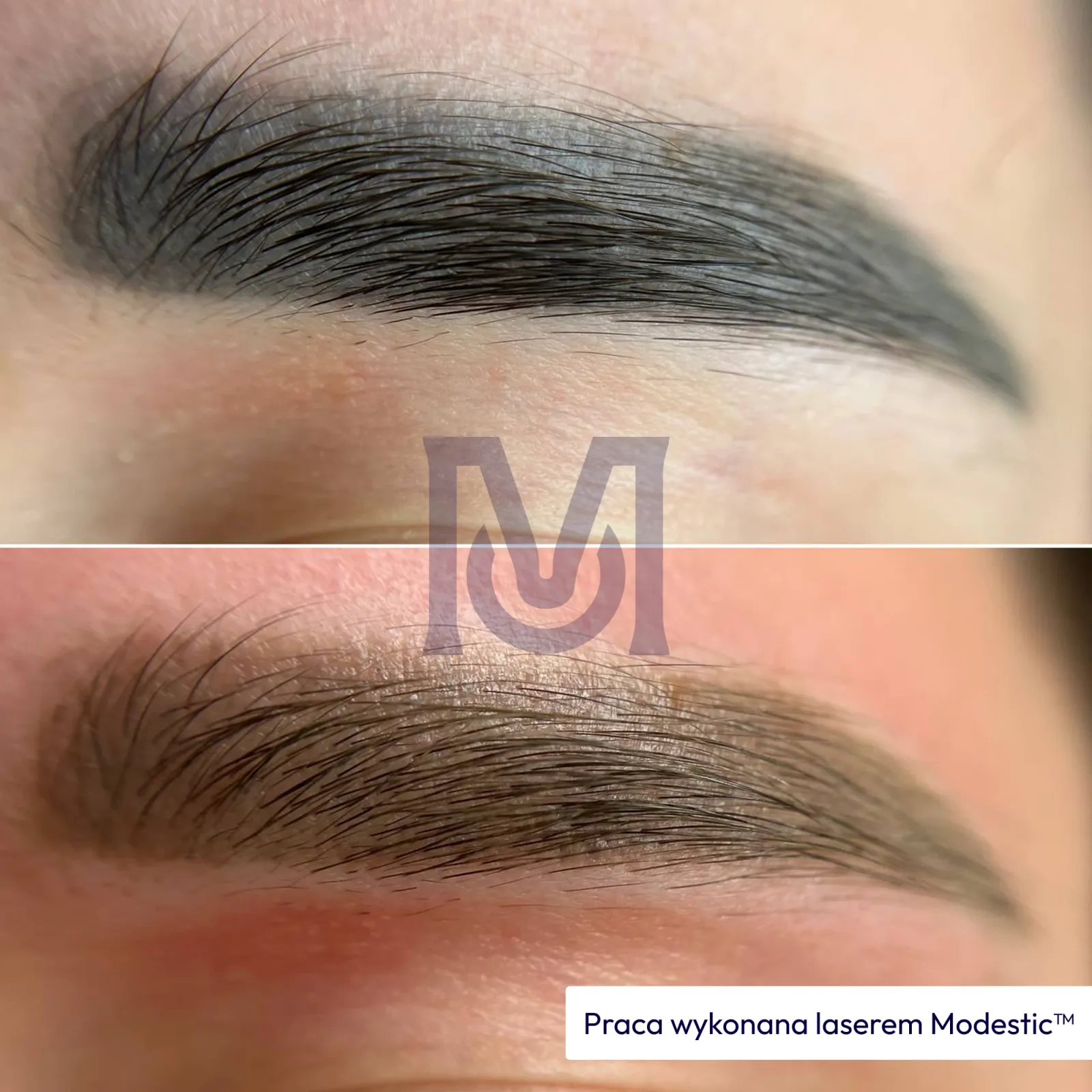 Result of work with a Modestic laser — 13