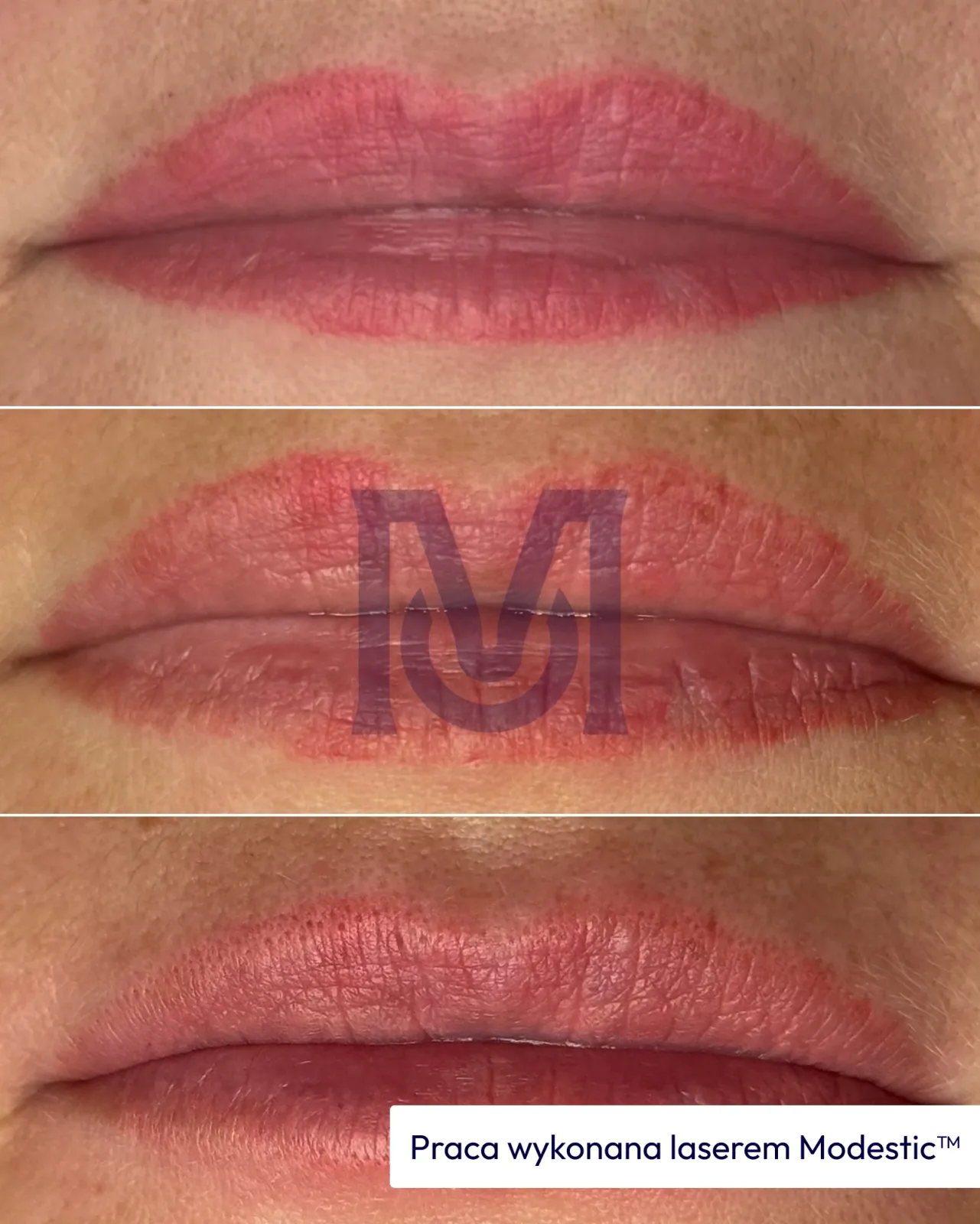 Result of work with a Modestic laser — 9