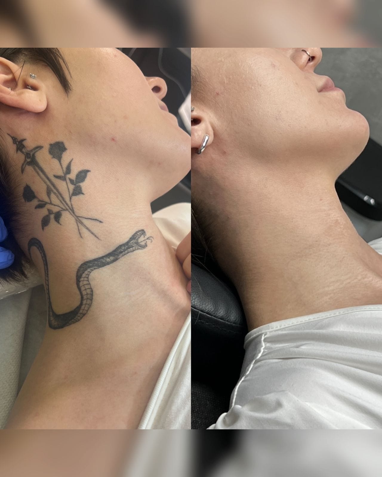 Usuwanie tatuażu z szyi, efekt przed i po