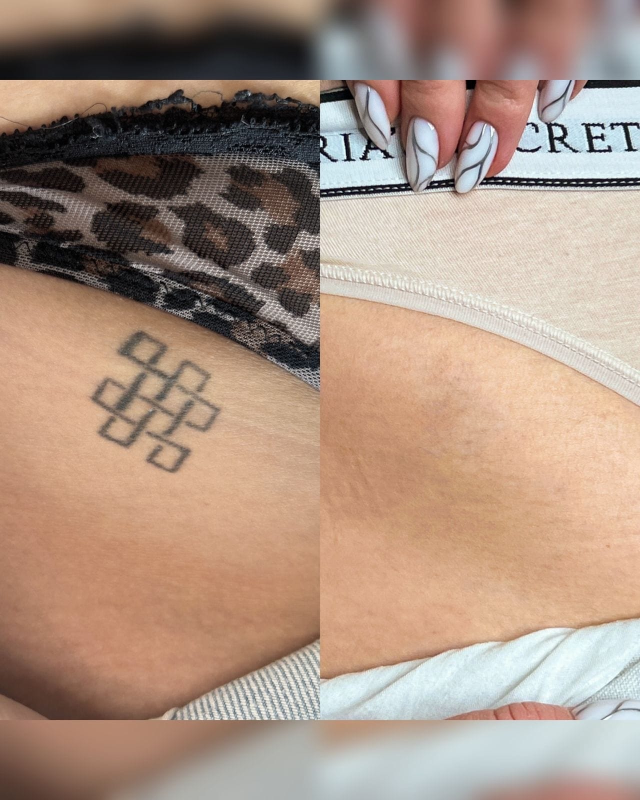Usuwanie tatuażu z biodra, efekt przed i po