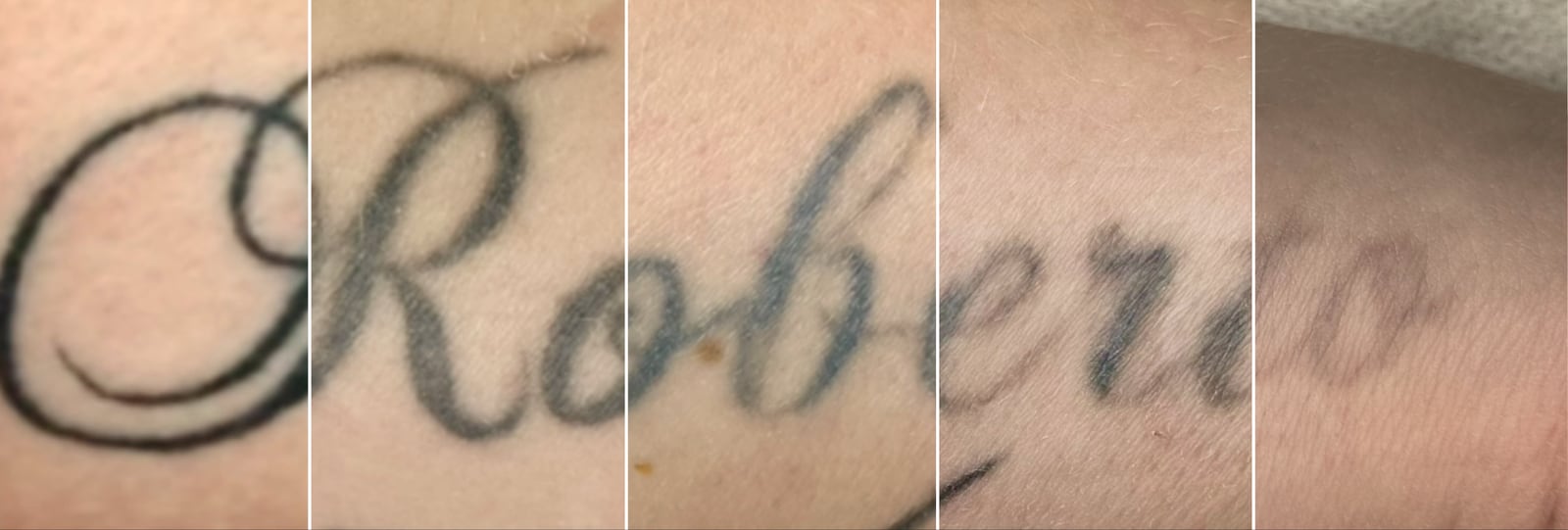 Ten sam tatuaż po kolejnych sesjach usuwania, od stanu wyjściowego do rozjaśnienia
