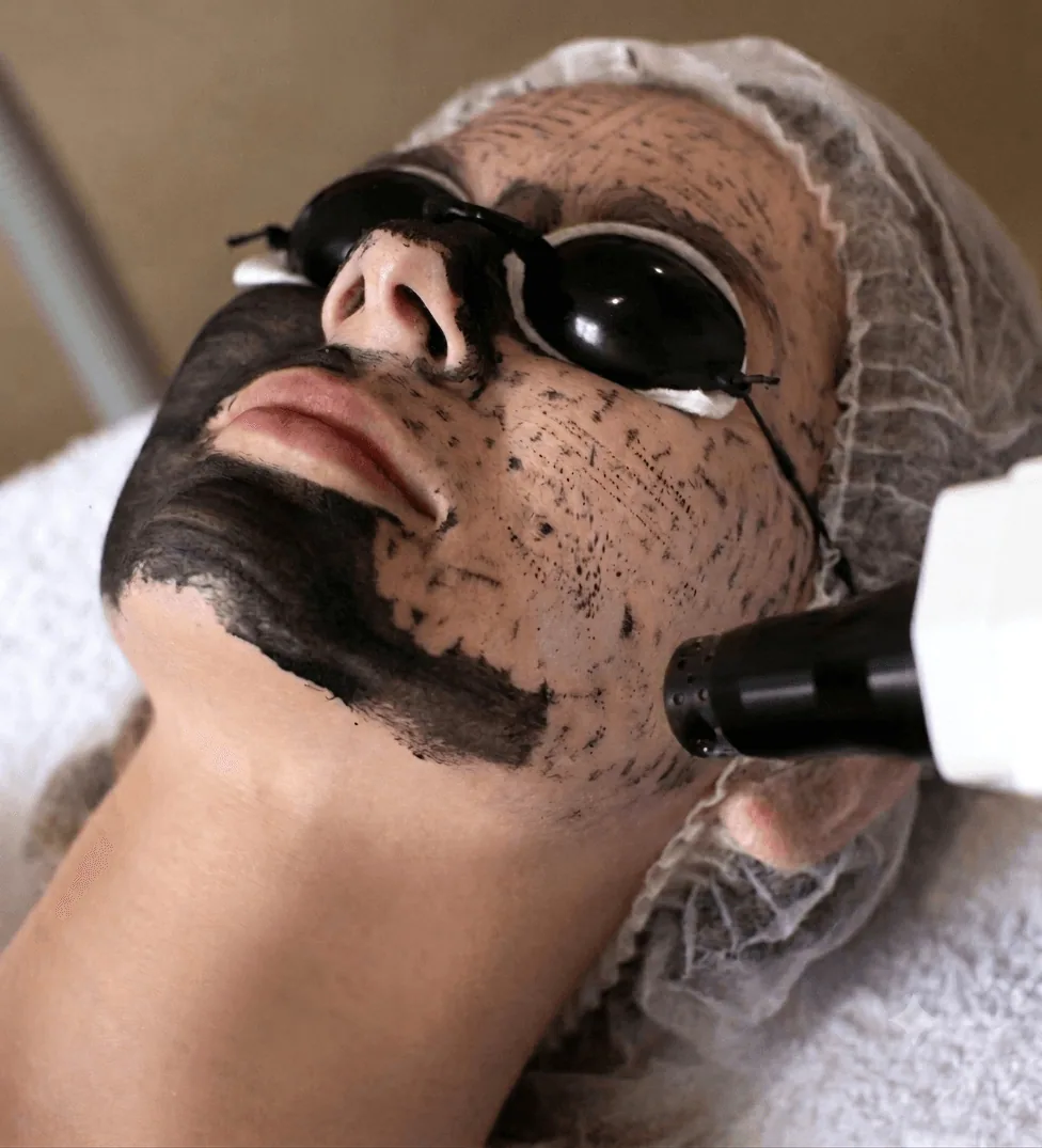 Carbon peel treatment