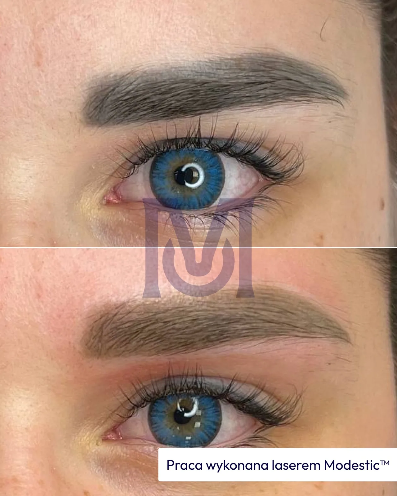 Modestic laser treatment result — eyeliner before and after