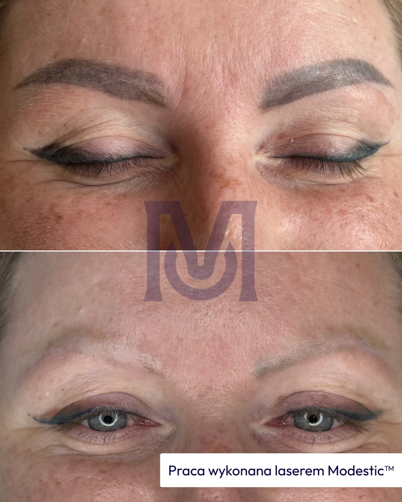 Modestic laser treatment result — brows before and after