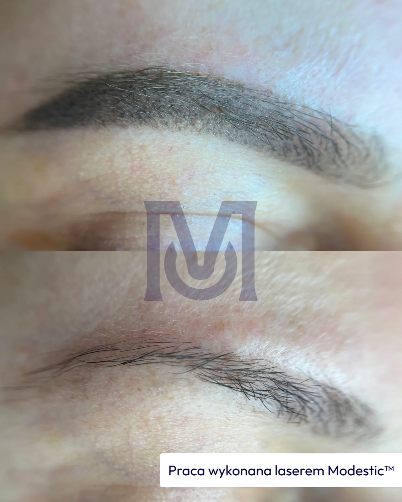 Modestic laser treatment result — brow lightening before and after