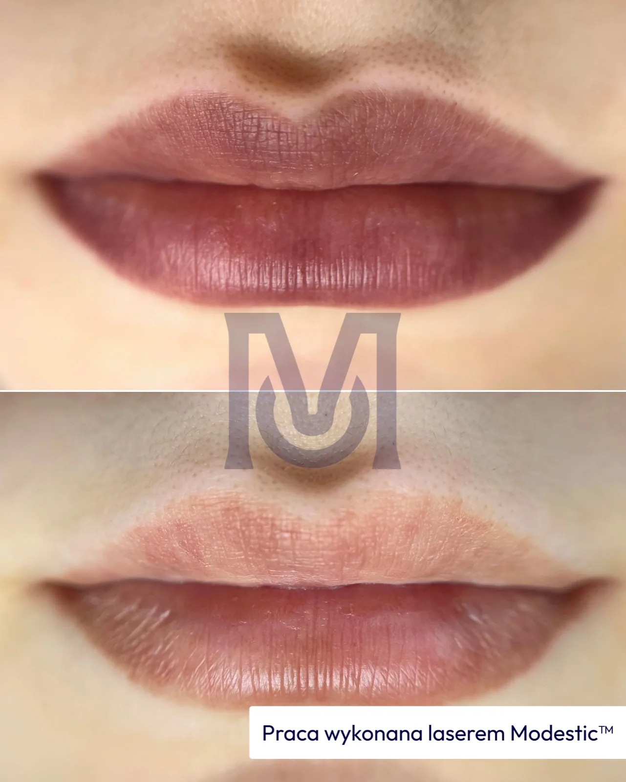 Modestic laser treatment result — lips before and after