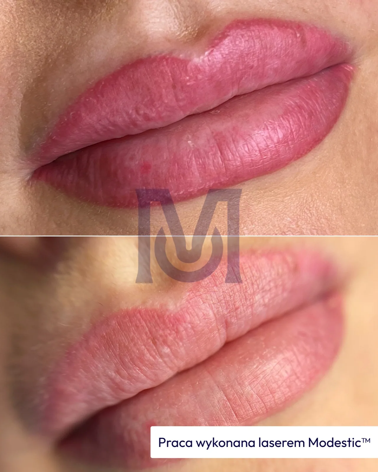Modestic laser treatment result — lip lightening before and after