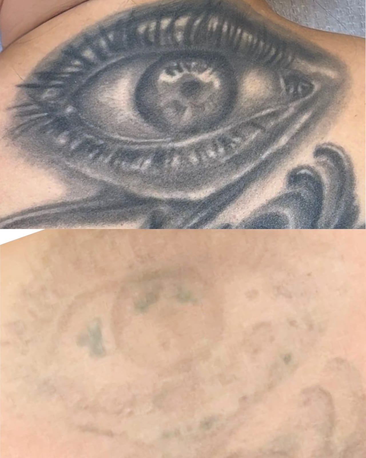 Usuwanie dużego tatuażu z ramienia laserem Modestic, efekt przed i po