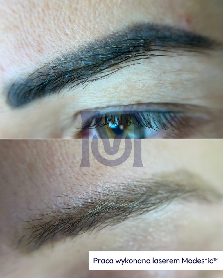 Skuteczne usuwanie makijażu permanentnego brwi - efekt przed i po - praca wykonana laserem Modestic™ w gabinecie w Warszawie