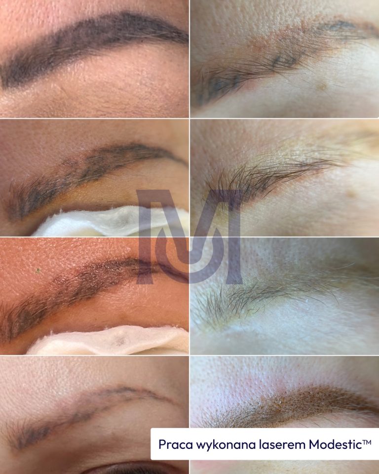 Proces usuwania brwi permanentnych laserem w Warszawie w gabinecie Modestic™