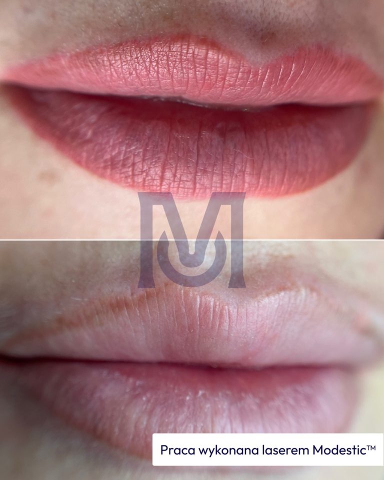 Skuteczne usuwanie permanentnych ust - efekt przed i po - praca wykonana laserem Modestic™ w gabinecie w Warszawie