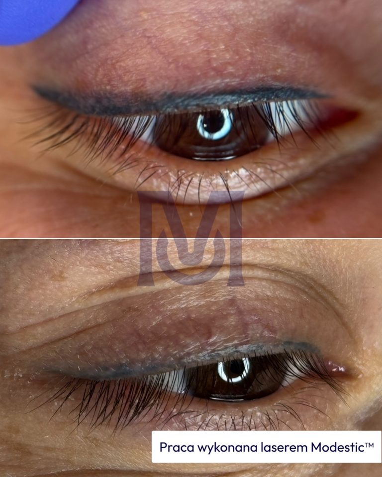 Skuteczne usuwanie permanentnych kresek - efekt przed i po - praca wykonana laserem Modestic™ w gabinecie w Warszawie