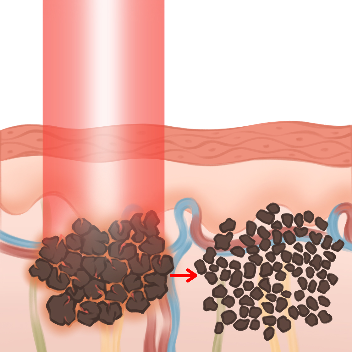 PRO laserowe usuwanie pigmentu