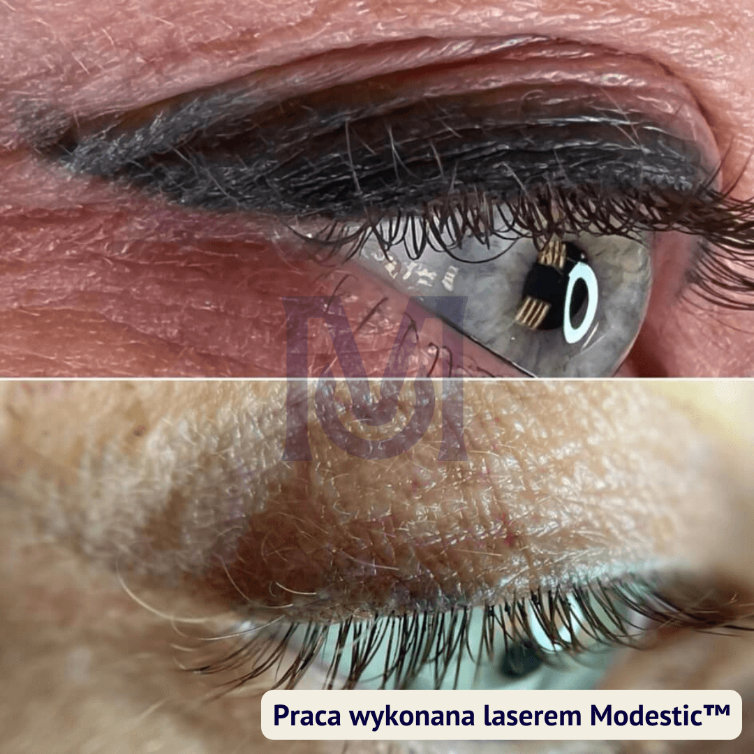 usuwanie makijażu permanentnego