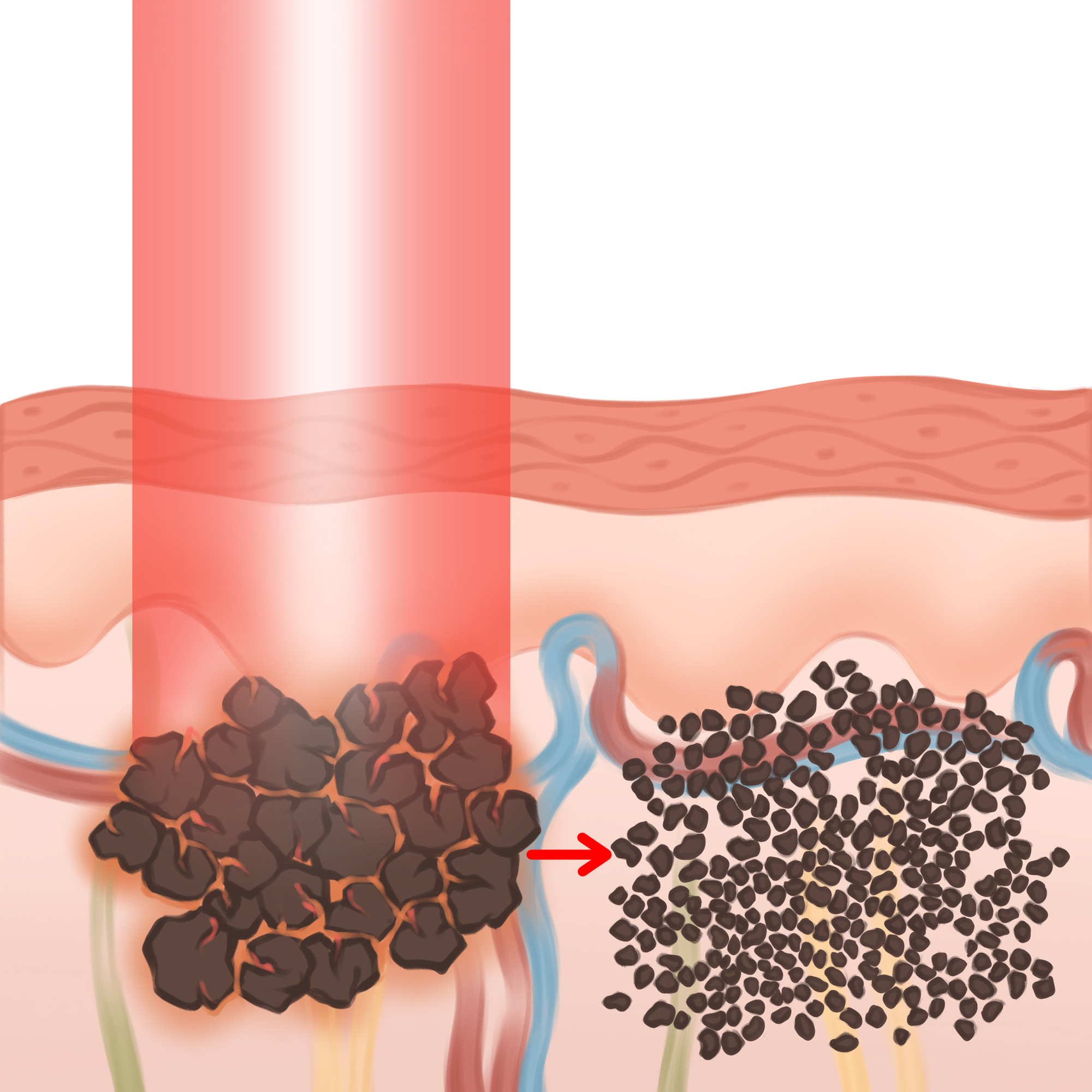 PICO laserowe usuwanie pigmentu