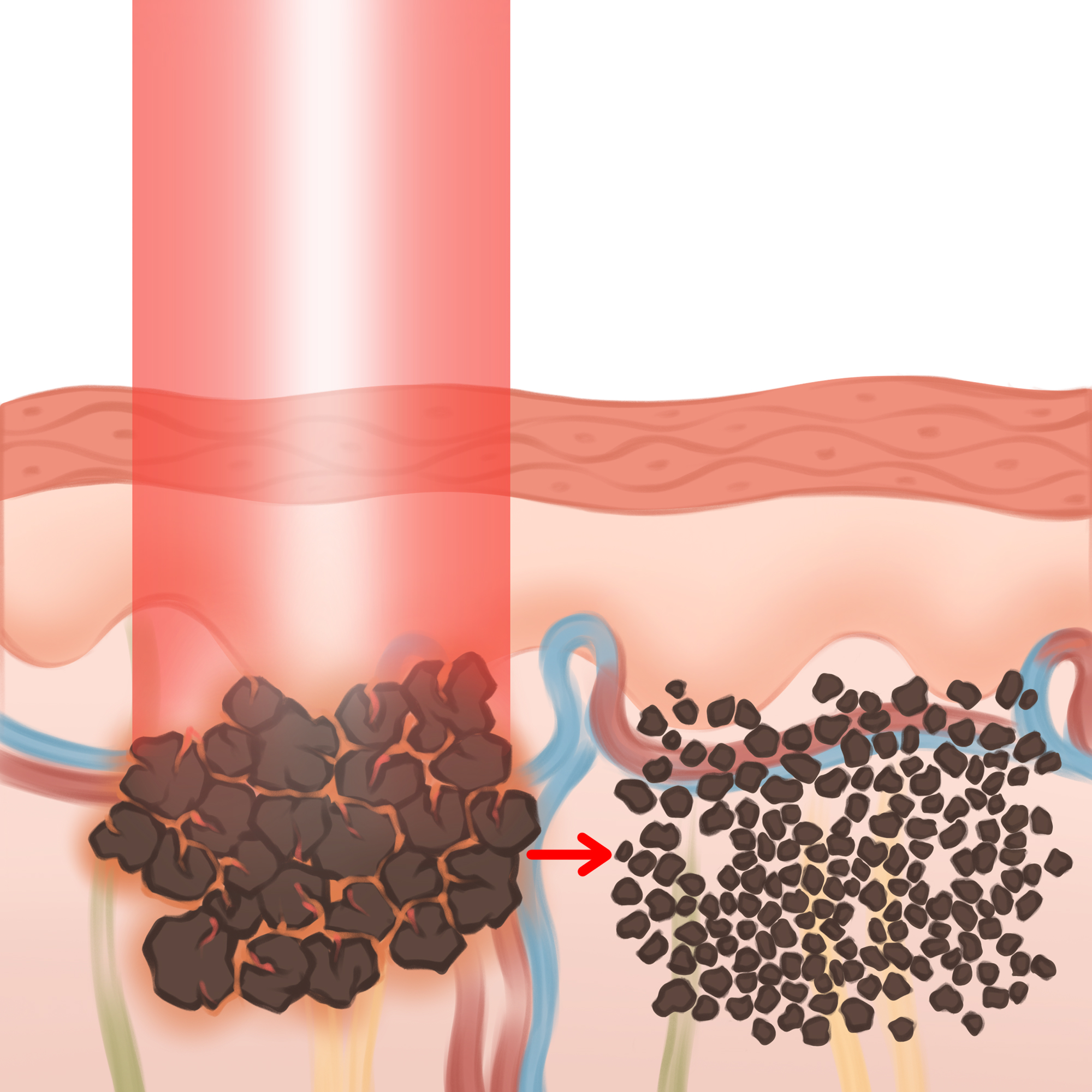 EDGE laserowe usuwanie pigmentu