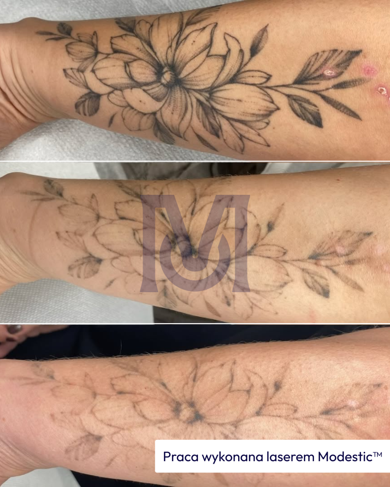 Proces usuwania czarnego pigmentu ze skóry: tatuaż napis przed zabiegiem i po sesjach laserem Modestic
