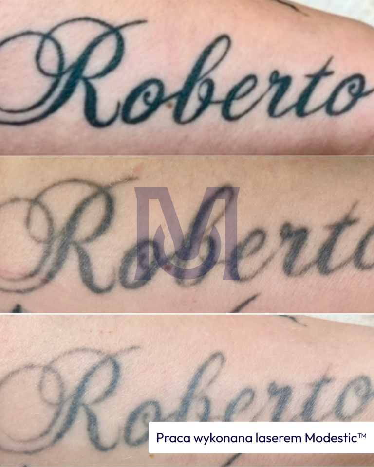 Efekt usuwania tatuażu napisu "Roberto" laserem Modestic – trzy etapy rozjaśniania pigmentu