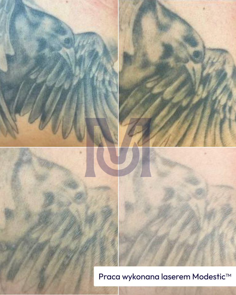 Porównanie efektów laserowego usuwania tatuażu z napisem na plecach – laser Modestic