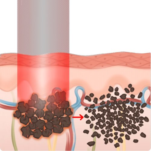 ULTRA laserowe usuwanie pigmentu - grafika pokazująca, jak laser usuwa pigment